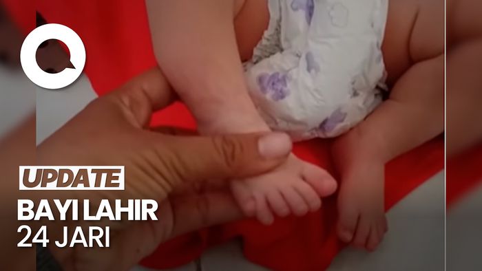 Heboh Bayi di Sampang Madura yang Lahir dengan 24 Jari