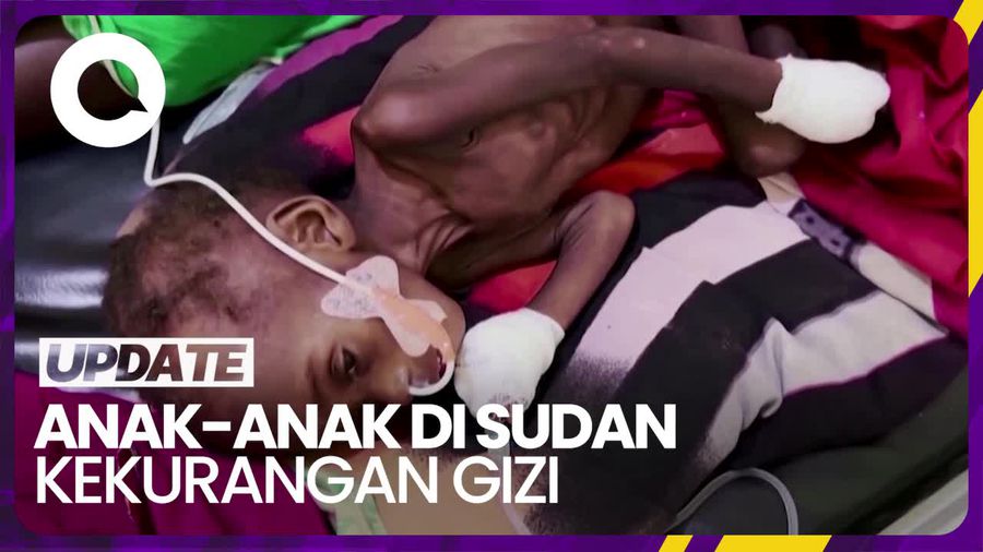 UNICEF: 700 Ribu Anak di Sudan Kemungkinan Alami Malnutrisi Akut