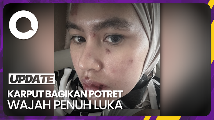 Potret Wajah Kartika Putri Dipenuhi Luka