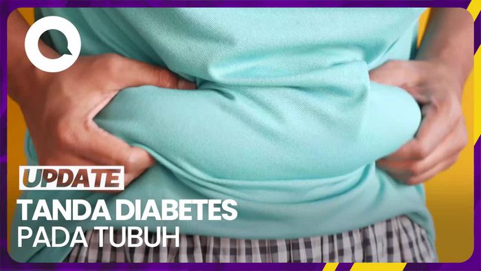 Perhatikan Tanda-tanda Obesitas pada Tubuh Berikut Ini