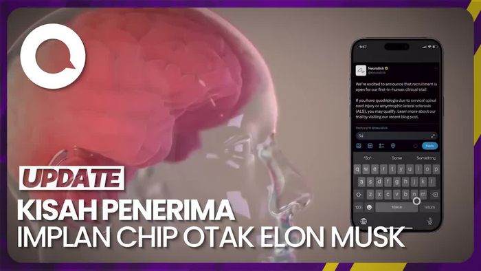 Pengakuan Manusia Pertama yang Terima Implan Chip Otak Elon Musk