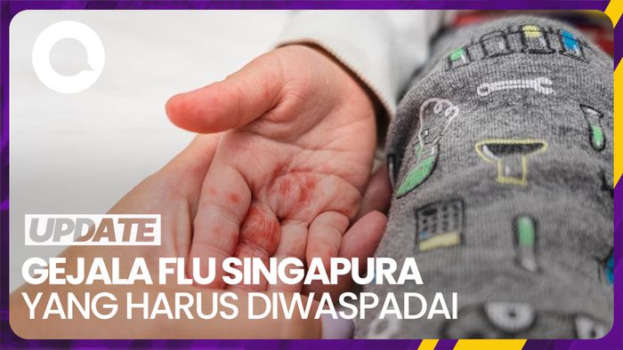 Tentang Flu Singapura: Masa Inkubasi hingga Gejala yang Muncul