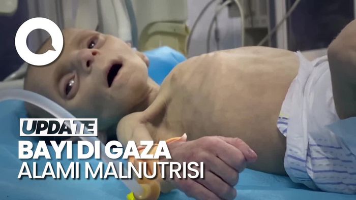 Pilu Bayi 2 Bulan di Gaza Berjuang Melawan Gizi Buruk