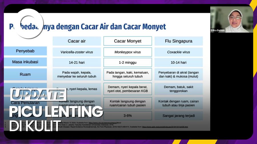 Ini Bedanya Cacar Air dan Flu Singapura Walau Sama-sama Picu Lenting di Kulit