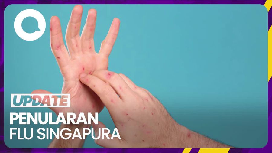 Hati-hati! Begini Cara Penularan Flu Singapura