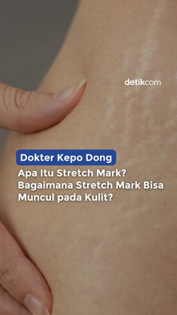 Stretch Mark pada Kulit