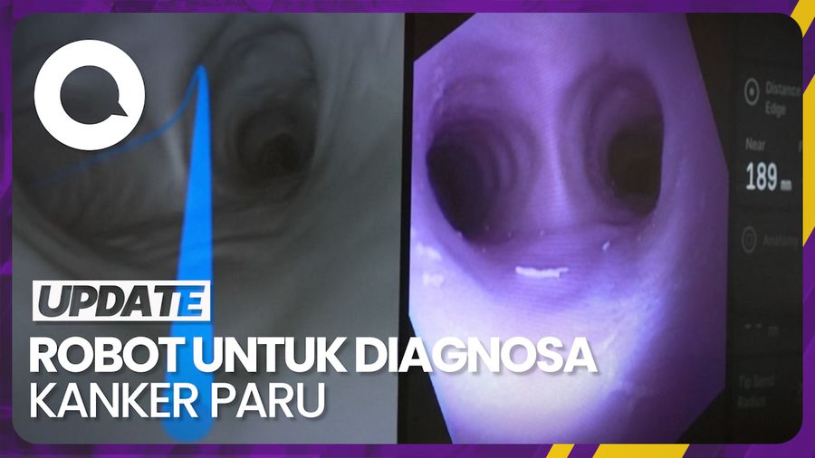 Melihat Kemampuan Robot yang Dapat Diagnosa Kanker Paru