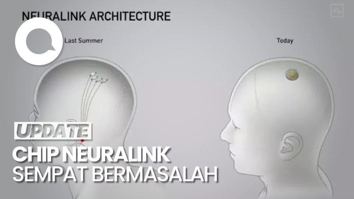 Chip yang Dipasang di Otak Manusia Sempat Bermasalah, Neuralink Klaim Tak Bahaya