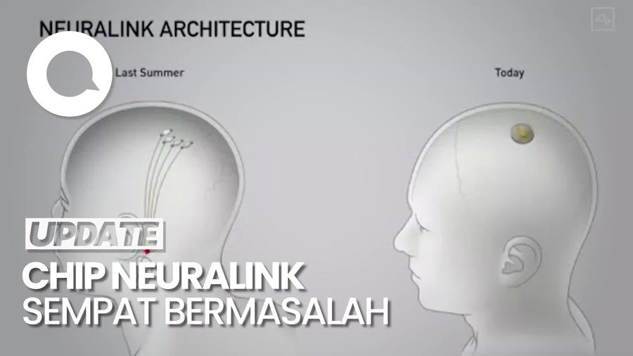 Chip yang Dipasang di Otak Manusia Sempat Bermasalah, Neuralink Klaim Tak Bahaya