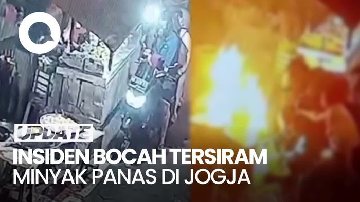 Bocah 3 Tahun Tersiram Minyak Panas Gegara Motor Tabrak Kompor di Jogja