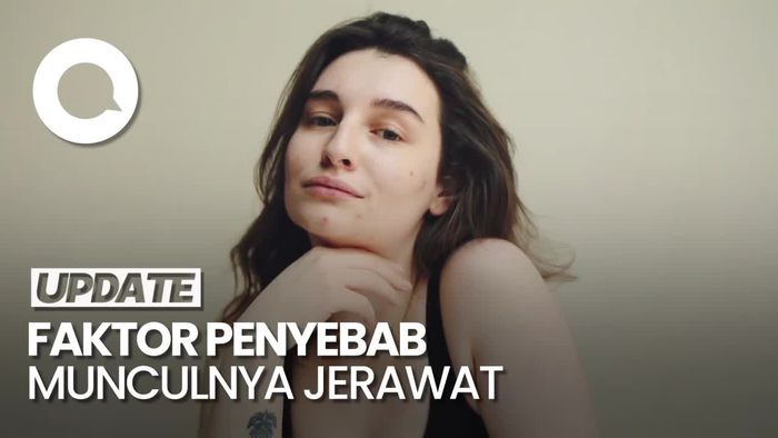 Catat! Ini 4 Penyebab Munculnya Jerawat
