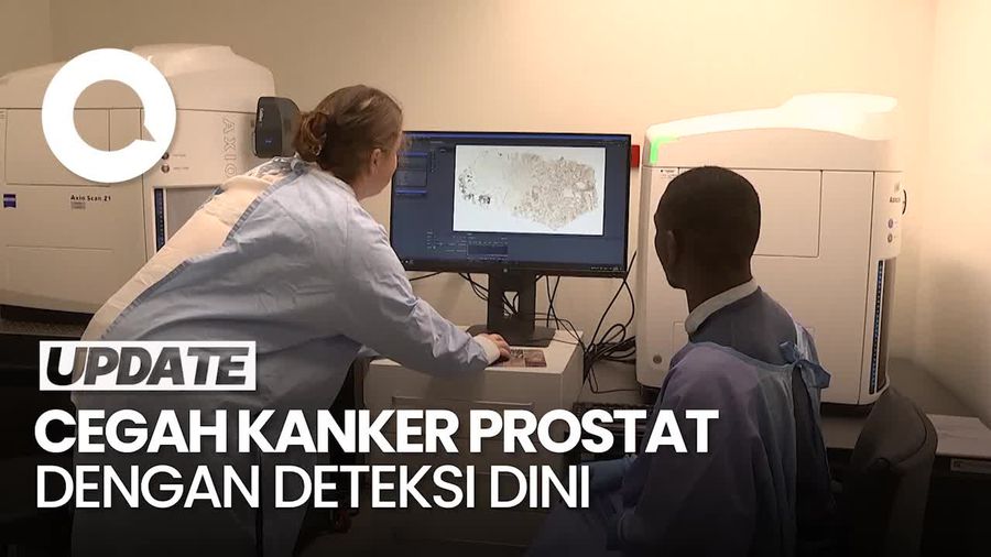 Peneliti Temukan Cara Baru Identifikasi Kanker Prostat Lebih Dini