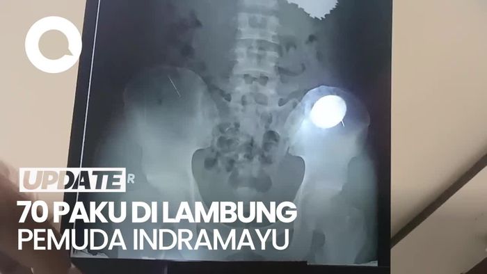 Ngeri, Penampakan Puluhan Paku di Lambung Pemuda Indramayu