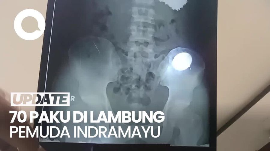 Ngeri, Penampakan Puluhan Paku di Lambung Pemuda Indramayu