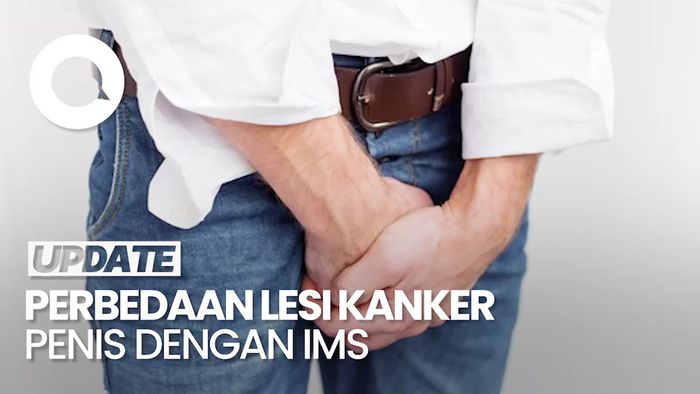 Kenali Perbedaan Lesi pada Kanker Penis dengan IMS