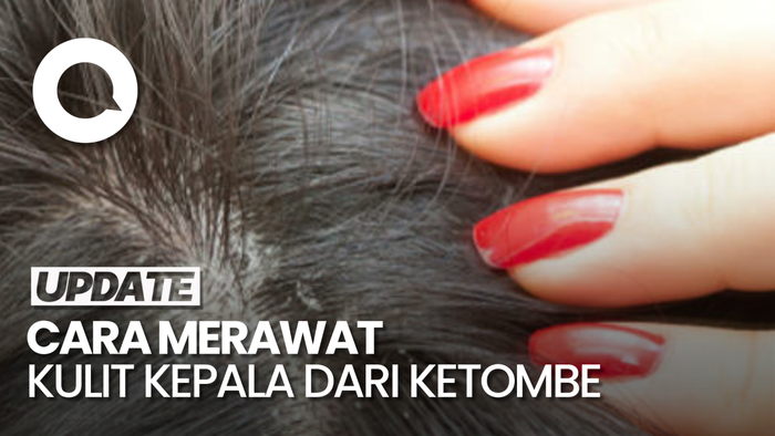  Hijab Sebabkan Ketombe? Begini Penjelasan Dokter SpKK