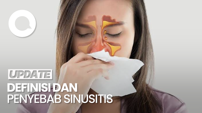 Mengenal Apa Itu Sinusitis dan Penyebabnya