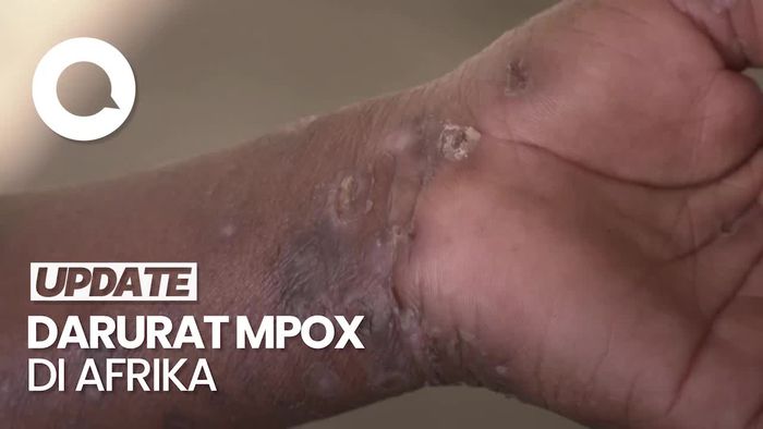 Deklarasi CDC Afrika soal Mpox Jadi Darurat Kesehatan yang Mengancam