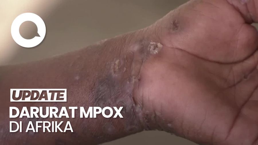 Deklarasi CDC Afrika soal Mpox Jadi Darurat Kesehatan yang Mengancam