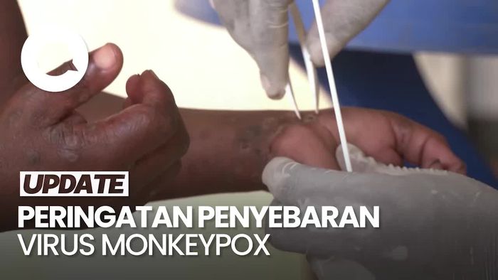 Wanti-wanti WHO-PBB Soal Penyebaran Virus Monkeypox ke Luar Afrika