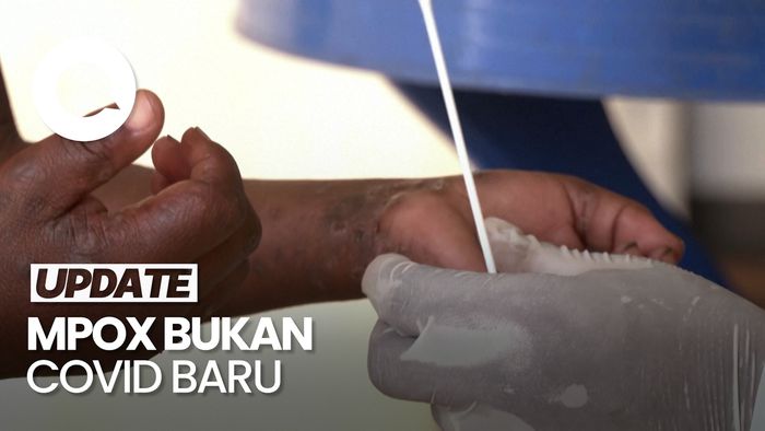 WHO: Cacar Monyet Mpox Bukan Covid Baru