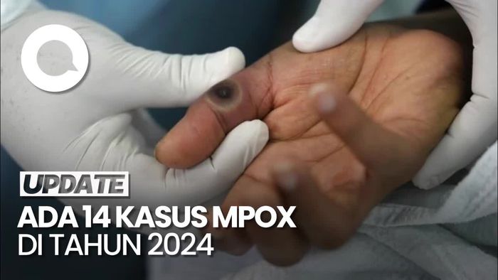 Kemenkes Temukan 14 Kasus Mpox di Tahun 2024