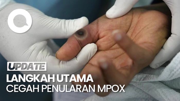 Kemenkes Ungkap Langkah Cegah Penularan Mpox