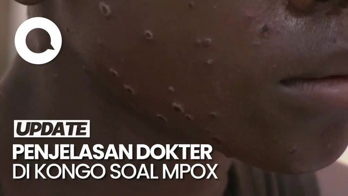 Mpox Dapat Sebabkan Komplikasi Serius
