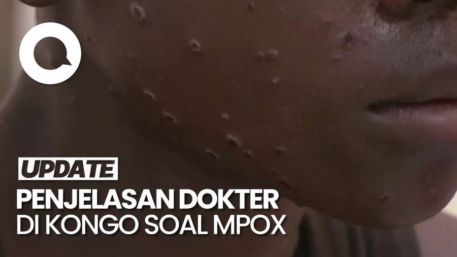 Mpox Dapat Sebabkan Komplikasi Serius