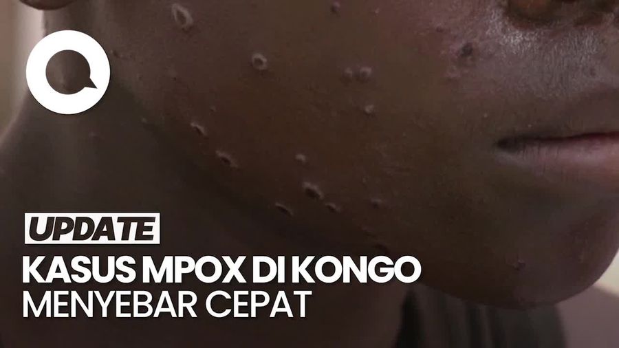 Mpox Menyebar Cepat, Jumlah Kematian di Kongo Capai 629