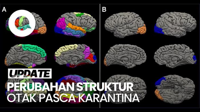 Peneliti Sebut Pandemi Covid Bikin Otak Remaja Perempuan Alami Penuaan Dini
