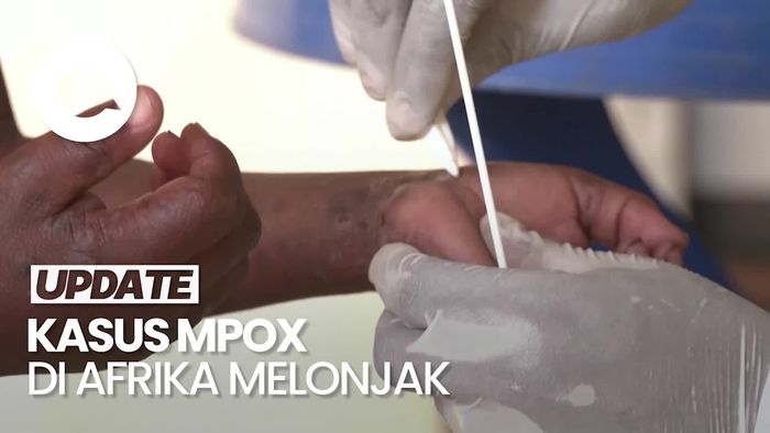 Wabah Mpox di Afrika Makin Tak Terkendali, Tembus Hampir 3.000 Kasus 
