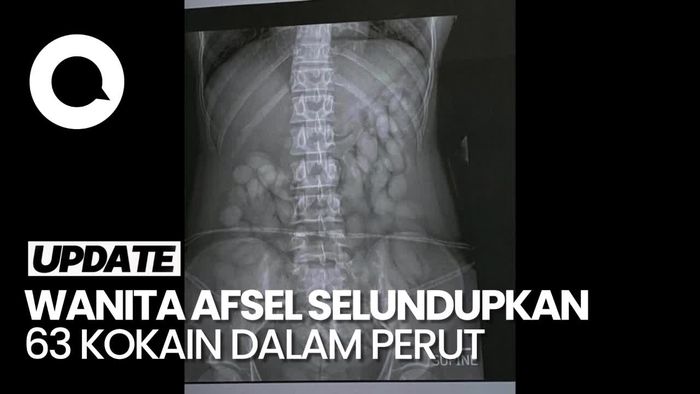 Penampakan Isi Perut Wanita Afrika Selatan, Penuh Narkoba Selundupan