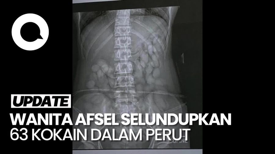 Penampakan Isi Perut Wanita Afrika Selatan, Penuh Narkoba Selundupan