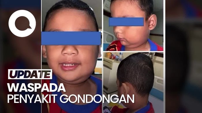 Video IDAI: Gondongan Bisa Picu Komplikasi hingga Ancam Jiwa
