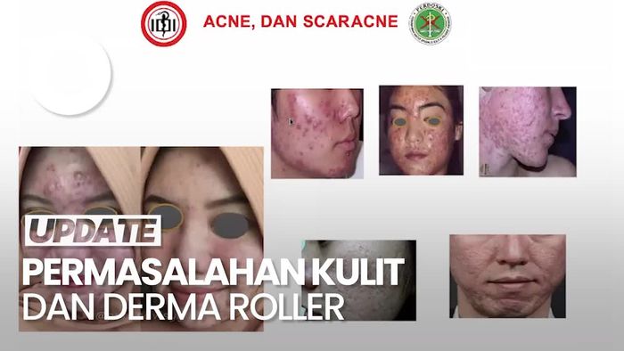 Video: Permasalahan Kulit yang Bisa Menggunakan Derma Roller