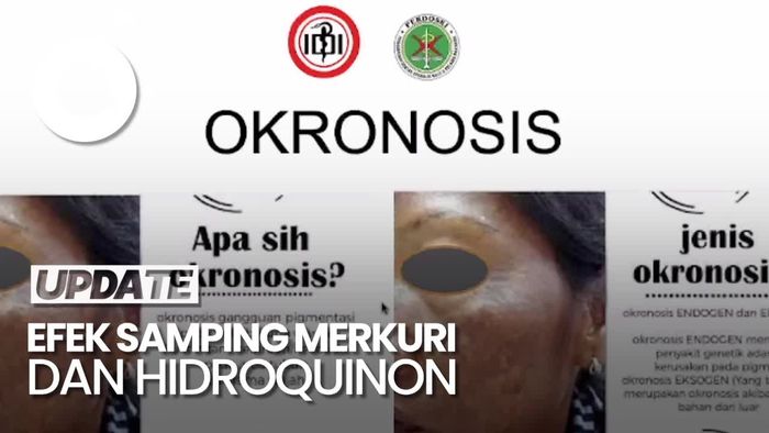 Video Bahaya Merkuri-Hidroquinon pada Kulit: Gagal Ginjal-Anak Down Syndrome