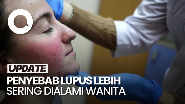 Video: Penjelasan Pakar soal Lupus Lebih Sering Terjadi pada Wanita