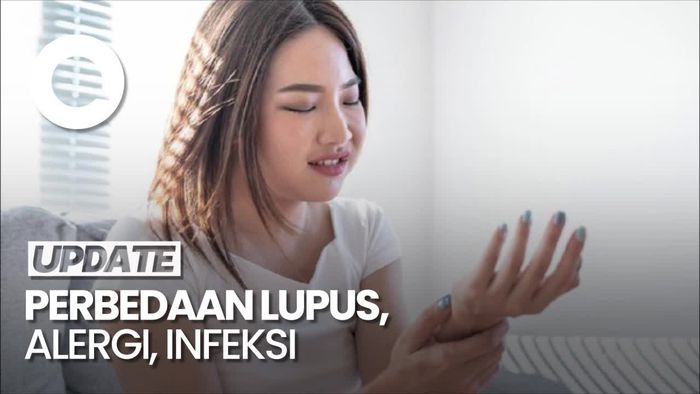 Video: Simak Yuk Bedanya Lupus, Alergi, dan Infeksi!