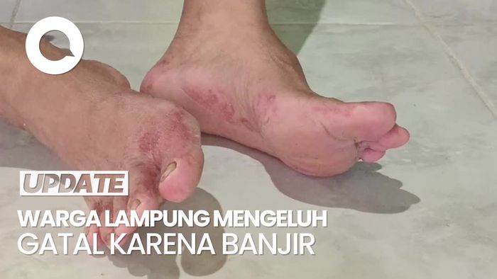 Video: Warga Lampung Mulai Gatal-gatal gegara Banjir