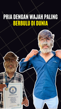 Video: Hipertrikosis, Kondisi yang Diidap Pria dengan Wajah Paling Berbulu Sedunia