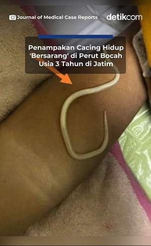 Video: Penampakan Cacing di Usus Bocah 3 Tahun di Jember