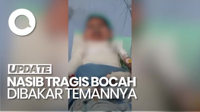 Video: Kronologi Bocah di Situbondo Kritis Setelah Dibakar 4 Temannya