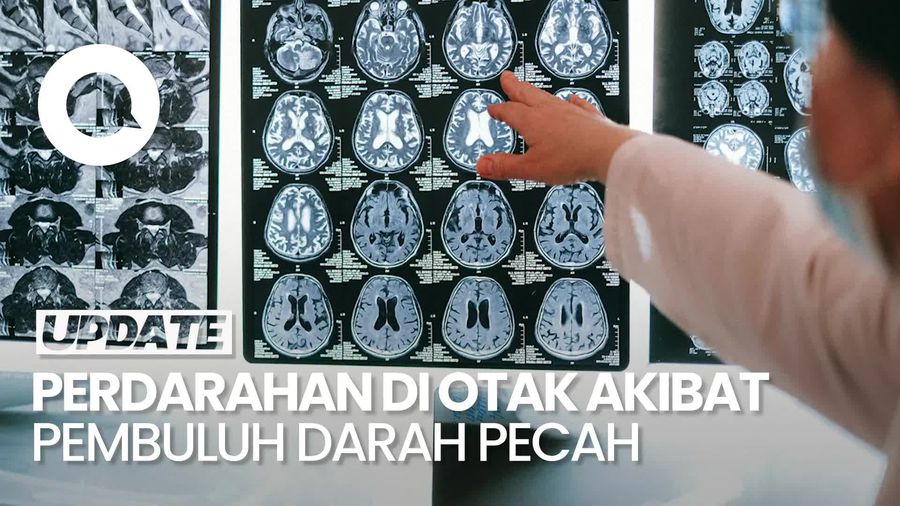 Video: Kenali Gejala Stroke Hemoragik yang Bikin Perdarahan di Otak