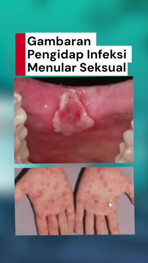 Video: Gambaran Seseorang yang Terinfeksi Penyakit Menular Seksual 