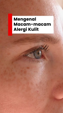 Video: Mengenal Jenis Alergi Kulit, Biduran Hingga Stevens Johnson Syndrome