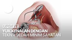 Video: Pernah Dengar Laparoskopi? Ini Kata Dokter soal Keunggulannya