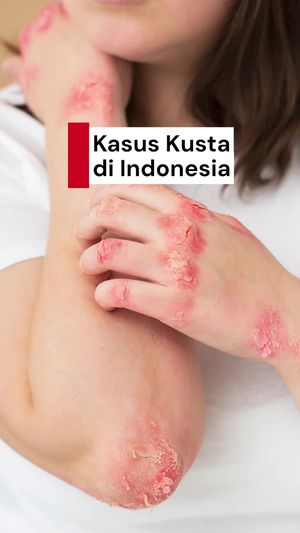 Video: Kasus Penyakit Kusta Indonesia Masuk 3 Besar Dunia