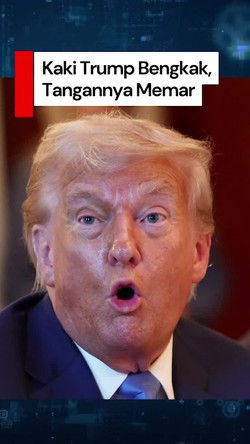 Video: Donald Trump Alami Pembengkakan di Kaki dan Memar di Tangan