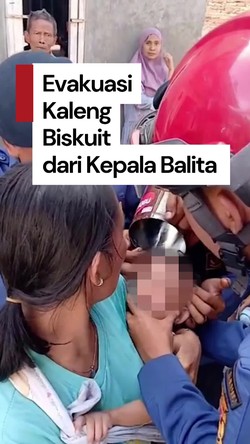 Video: Momen Evakuasi Kaleng Biskuit Tersangkut di Kepala Balita di Lampung